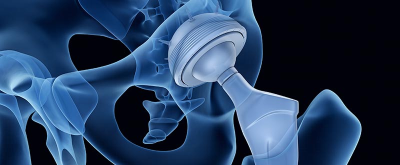 Smith & Nephew Hip Implant Lawsuits